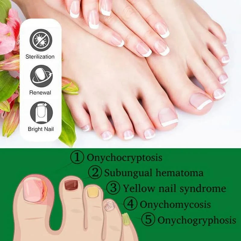 Nagelbehandlung – Natürliche Antipilzbehandlung 
